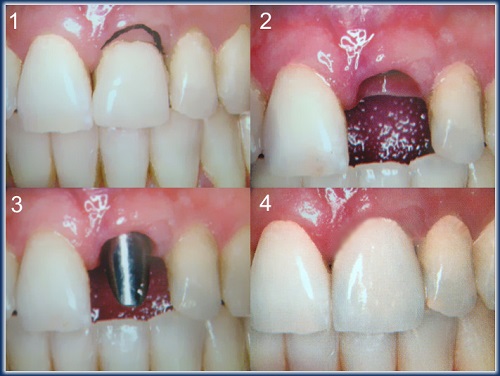 Implantes